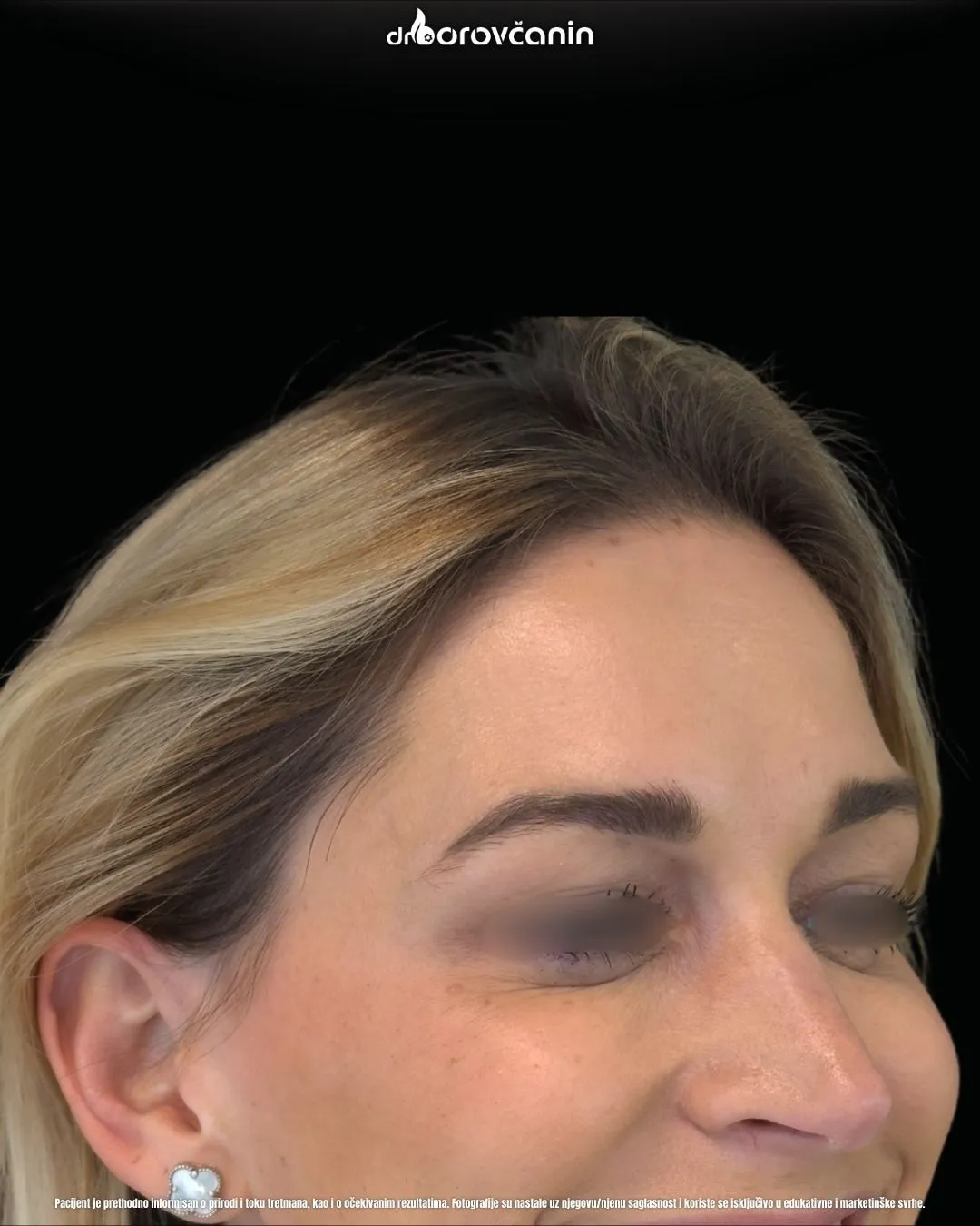 Botoks posle 3